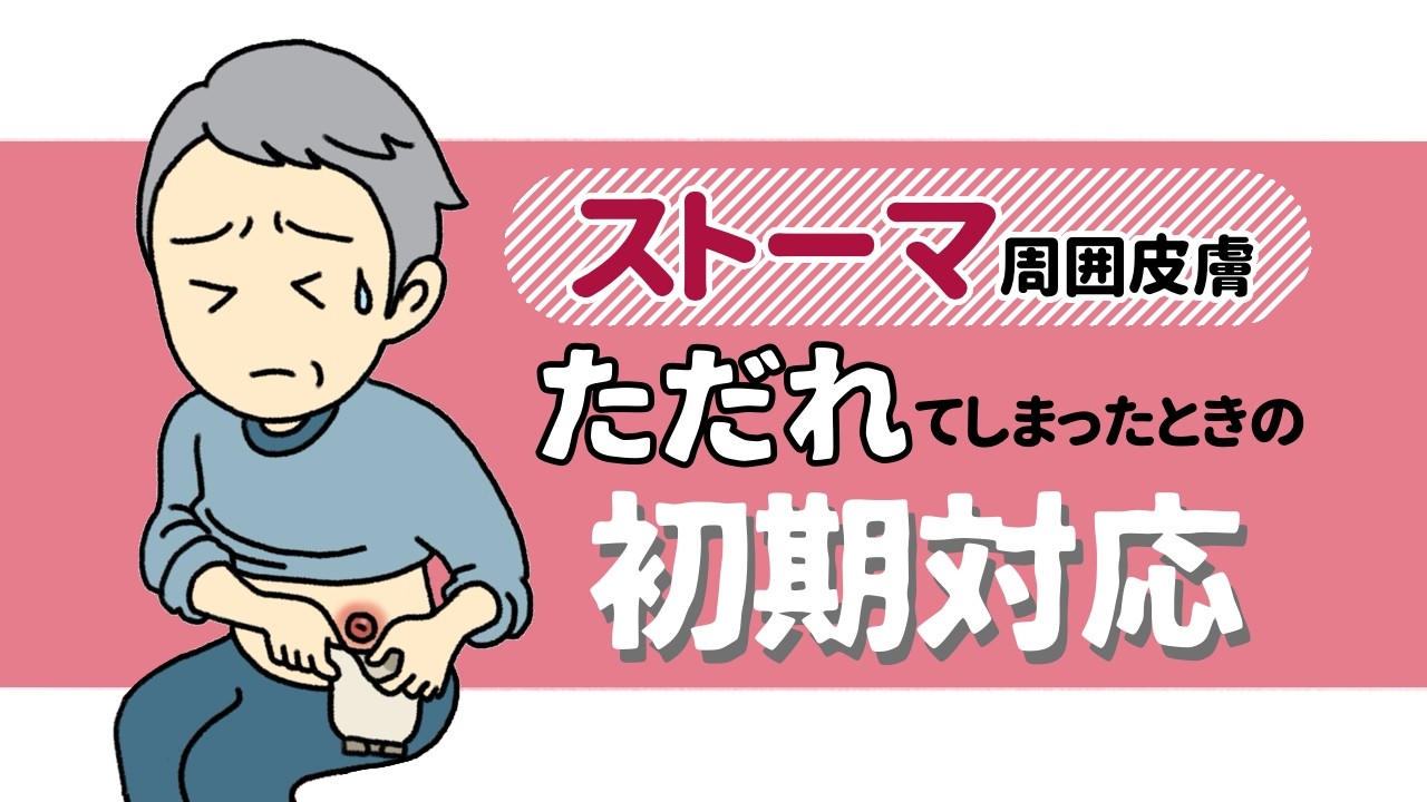 ストーマ周囲皮膚を守るために皮膚トラブル予防とただれてしまった時の初期対応